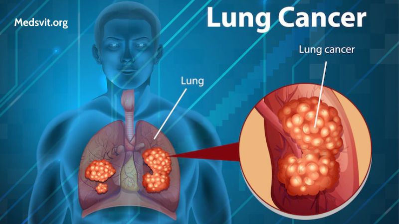 Risk Factors for Lung Cancer in Young Adults