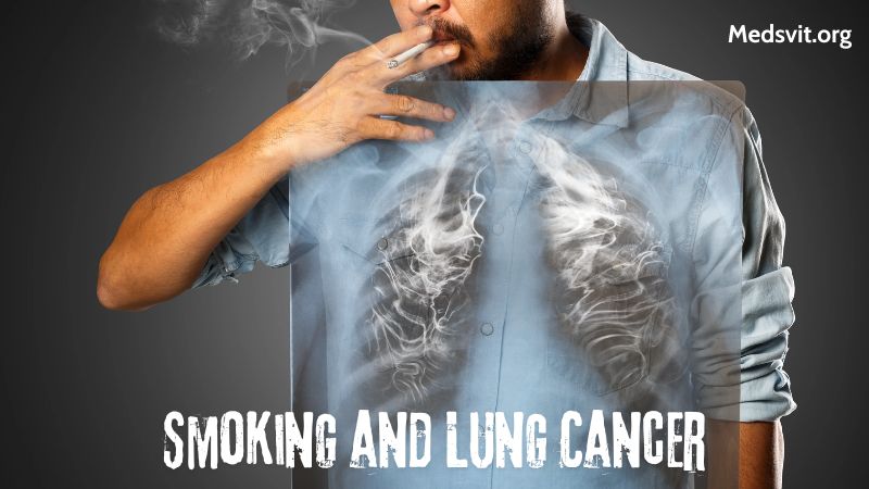 The Causes of Lung Cancer