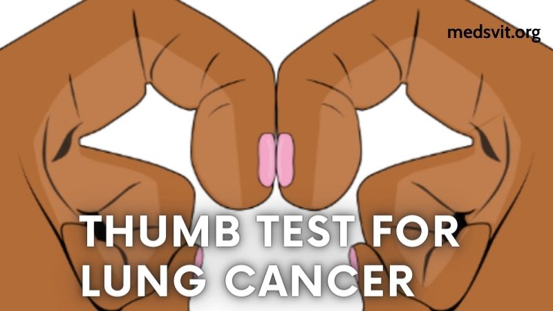 The Myth of the Thumb Test for Lung Cancer: Separating Fact from Fiction