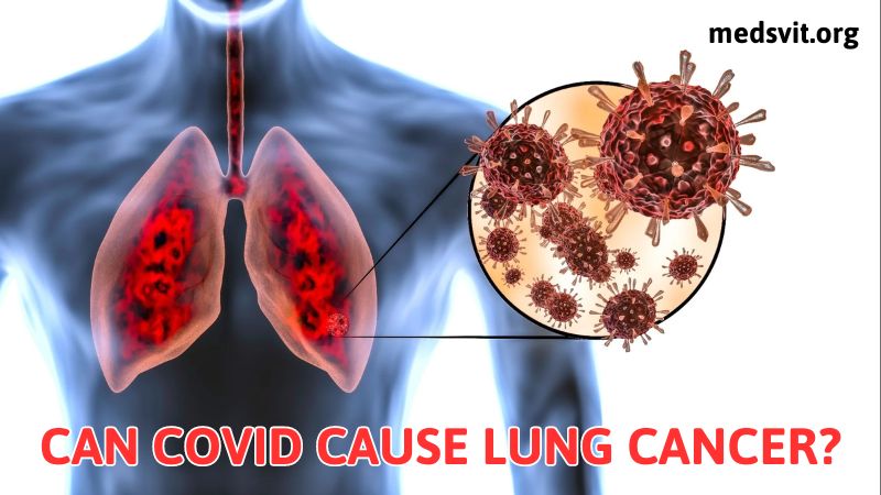 Debunking the Myth: Can COVID Cause Lung Cancer?