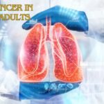 Lung Cancer in Young Adults