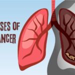 The Causes of Lung Cancer