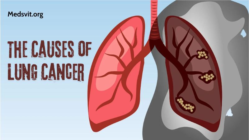 Understanding the Causes of Lung Cancer: A Comprehensive Overview